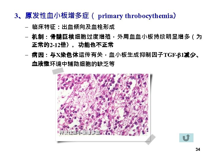 3、原发性血小板增多症（ primary throbocythemia） – 临床特征：出血倾向及血栓形成 – 机制：骨髓巨核细胞过度增殖，外周血血小板持续明显增多（为 正常的2 -12倍），功能也不正常 – 病因：与X染色体遗传有关，血小板生成抑制因子TGF- 1减少、 血液微环境中辅助细胞的缺乏等 34