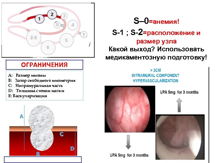 Интрамуральный узел. Васкуляризация миоматозных узлов. Интрамуральное Введение это. Интрамуральный компонент. Интрамуральный узел 11мм.