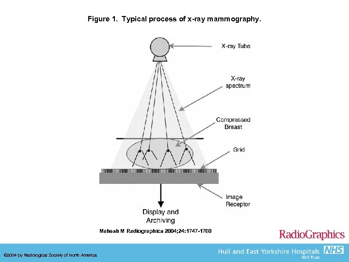 Figure 1. Typical process of x-ray mammography. Mahesh M Radiographics 2004; 24: 1747 -1760