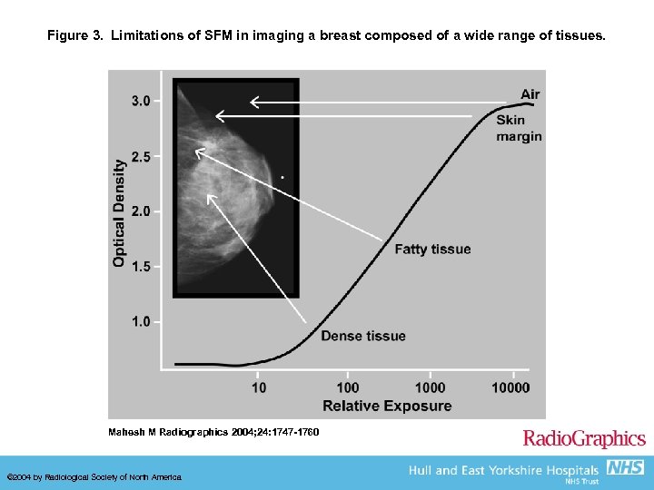 Figure 3. Limitations of SFM in imaging a breast composed of a wide range