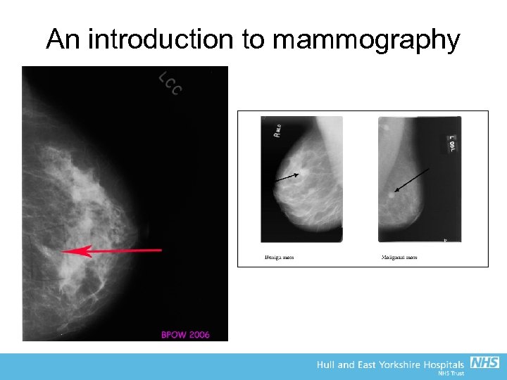 An introduction to mammography 