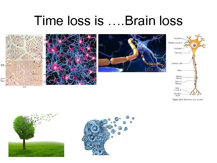 Time loss is …. Brain loss 