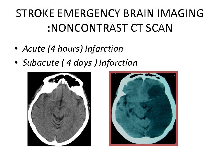 STROKE EMERGENCY BRAIN IMAGING : NONCONTRAST CT SCAN • Acute (4 hours) Infarction •