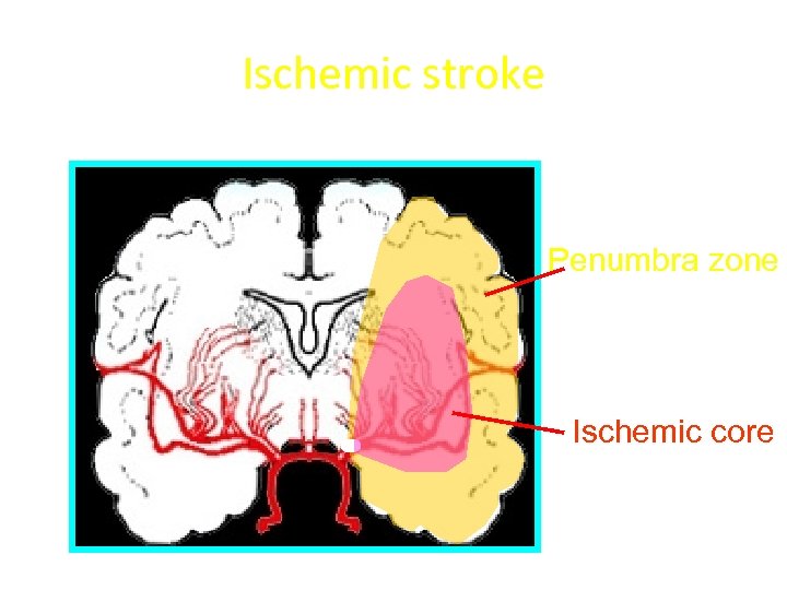 Ischemic stroke Penumbra zone Ischemic core 