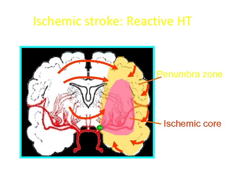 Ischemic stroke: Reactive HT Penumbra zone Ischemic core 