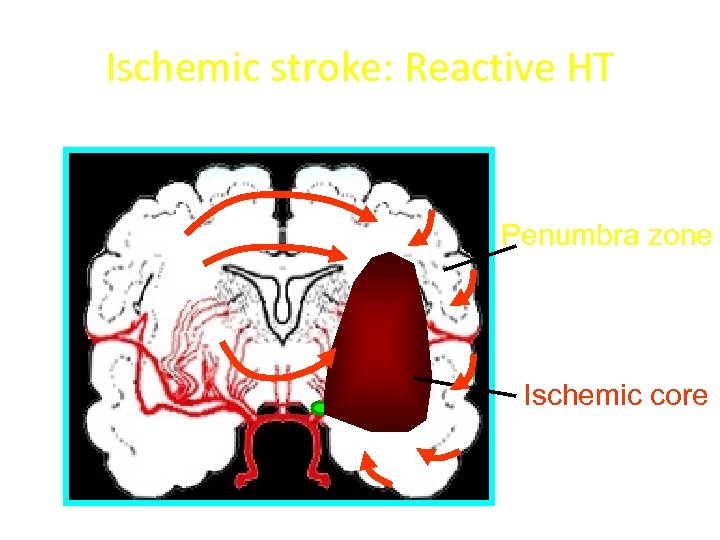 Ischemic stroke: Reactive HT Penumbra zone Ischemic core 