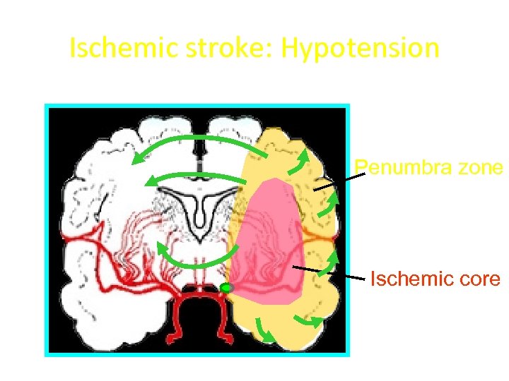 Ischemic stroke: Hypotension Penumbra zone Ischemic core 