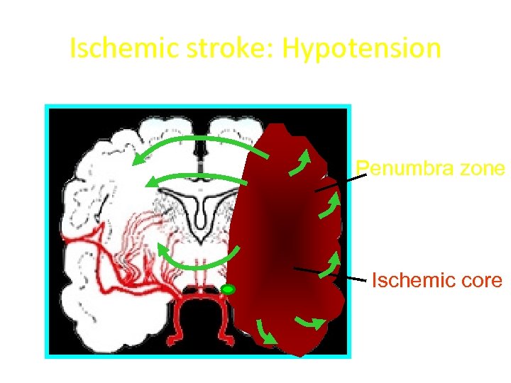 Ischemic stroke: Hypotension Penumbra zone Ischemic core 