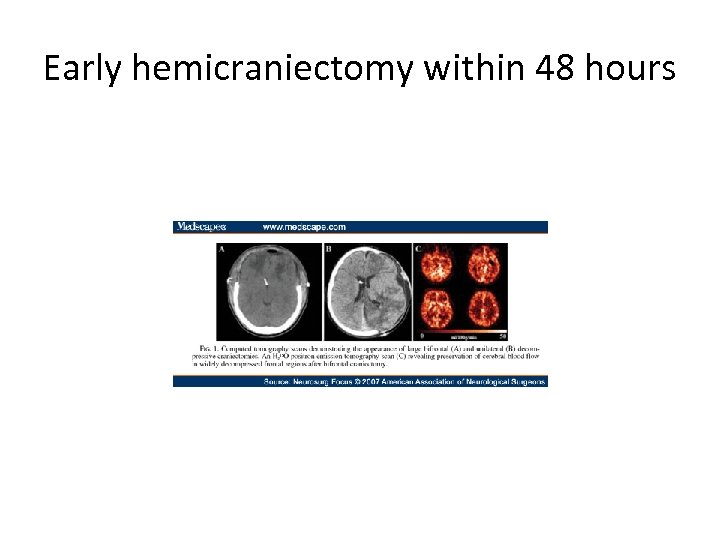 Early hemicraniectomy within 48 hours 