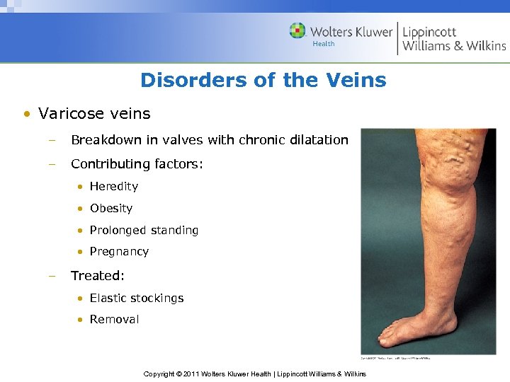 Disorders of the Veins • Varicose veins – Breakdown in valves with chronic dilatation