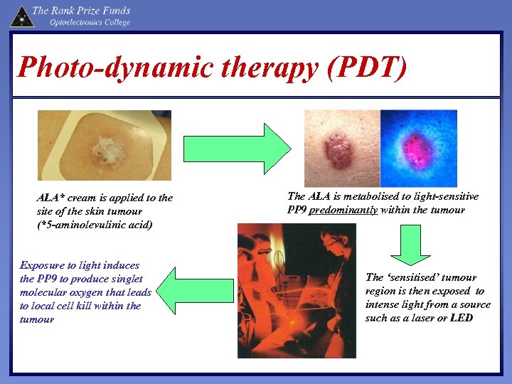 Photo-dynamic therapy (PDT) ALA* cream is applied to the site of the skin tumour