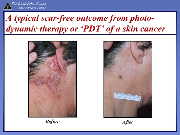 A typical scar-free outcome from photodynamic therapy or ‘PDT’ of a skin cancer Before