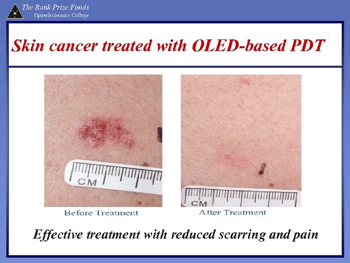 Skin cancer treated with OLED-based PDT Effective treatment with reduced scarring and pain 