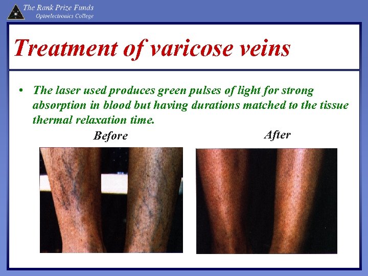Treatment of varicose veins • The laser used produces green pulses of light for