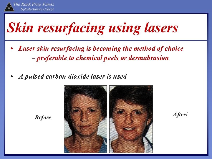 Skin resurfacing using lasers • Laser skin resurfacing is becoming the method of choice