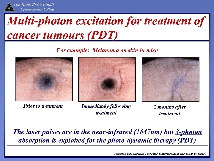 Multi-photon excitation for treatment of cancer tumours (PDT) For example: Melanoma on skin in