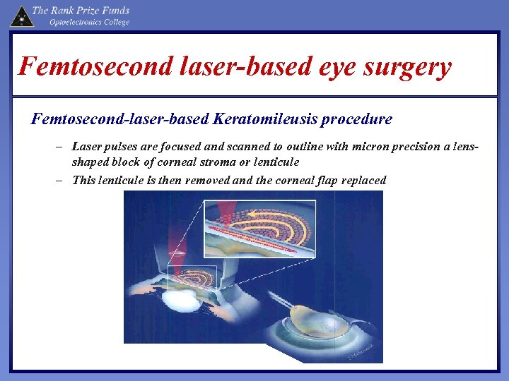 Femtosecond laser-based eye surgery Femtosecond-laser-based Keratomileusis procedure – Laser pulses are focused and scanned