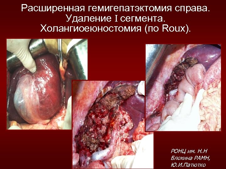 Расширенная гемигепатэктомия справа. Удаление I сегмента. Холангиоеюностомия (по Roux). РОНЦ им. Н. Н Блохина