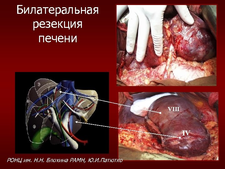 Билатеральная резекция печени VIII IV РОНЦ им. Н. Н. Блохина РАМН, Ю. И. Патютко