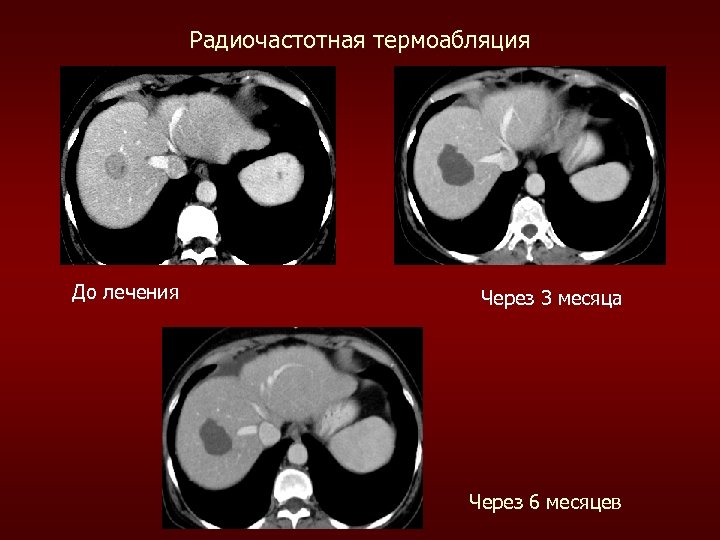 Радиочастотная термоабляция До лечения Через 3 месяца Через 6 месяцев 