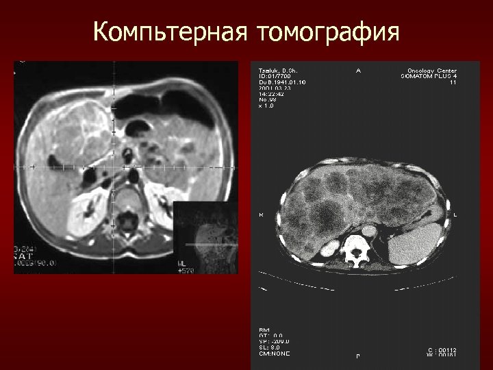 Компьтерная томография 