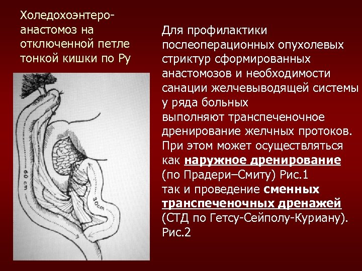 Холедохоэнтероанастомоз на отключенной петле тонкой кишки по Ру Для профилактики послеоперационных опухолевых стриктур сформированных