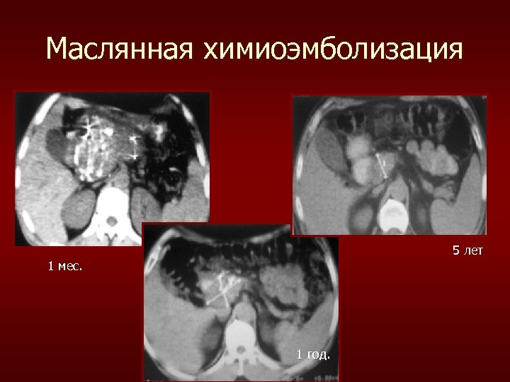 Маслянная химиоэмболизация 5 лет 1 мес. 1 год. 