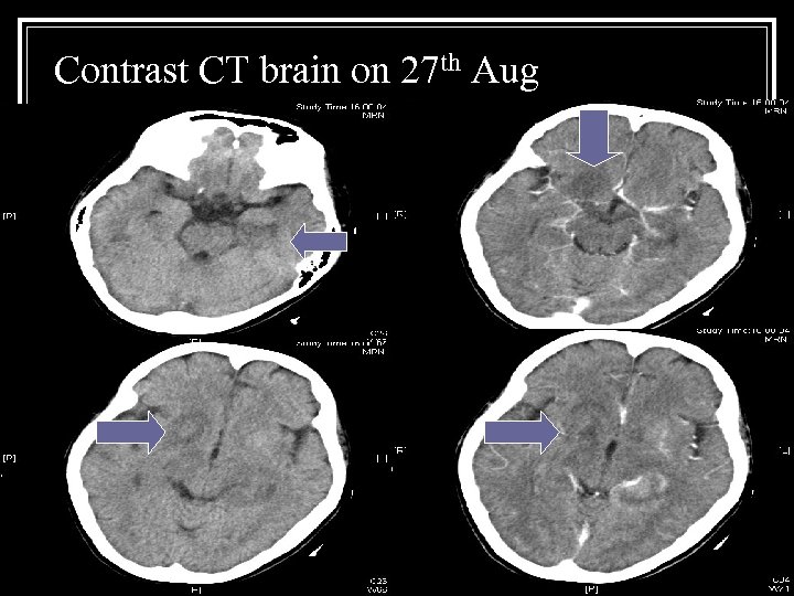 Contrast CT brain on 27 th Aug 