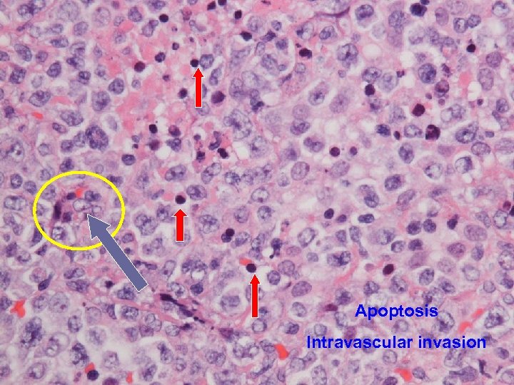 Apoptosis Intravascular invasion 