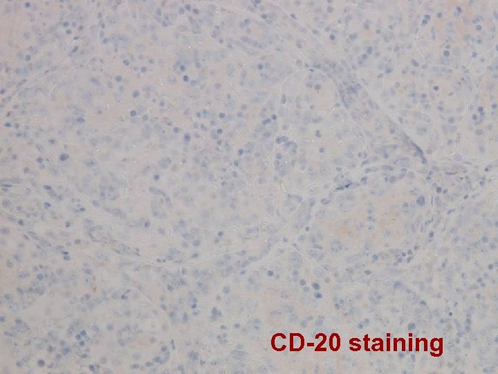 CD-20 staining 