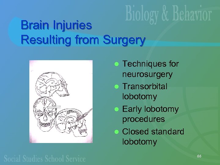 Brain Injuries Resulting from Surgery Techniques for neurosurgery l Transorbital lobotomy l Early lobotomy