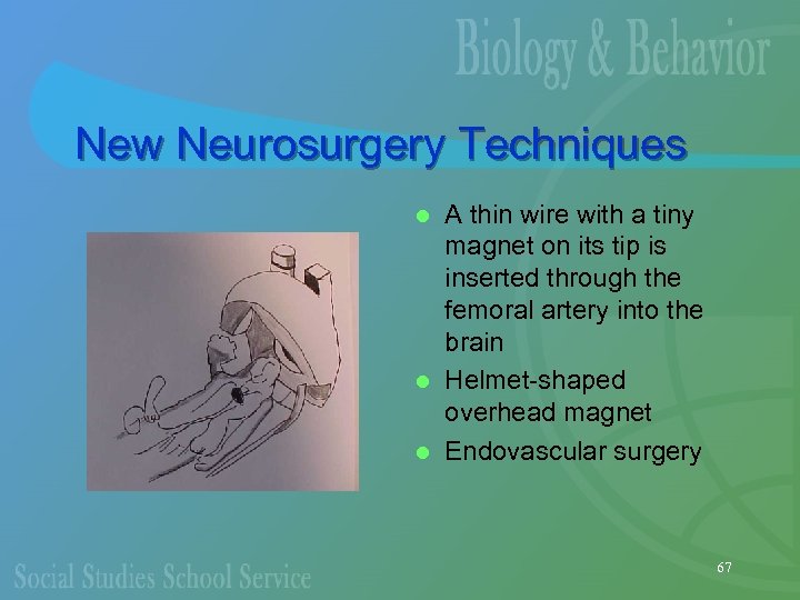 New Neurosurgery Techniques A thin wire with a tiny magnet on its tip is