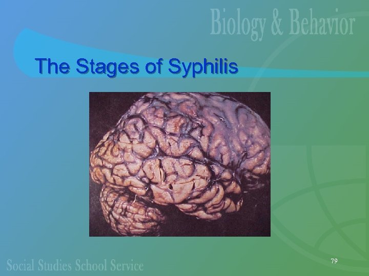 The Stages of Syphilis 79 
