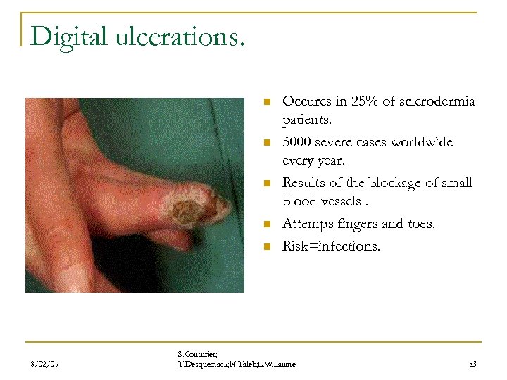 Digital ulcerations. n n n 8/02/07 Occures in 25% of sclerodermia patients. 5000 severe