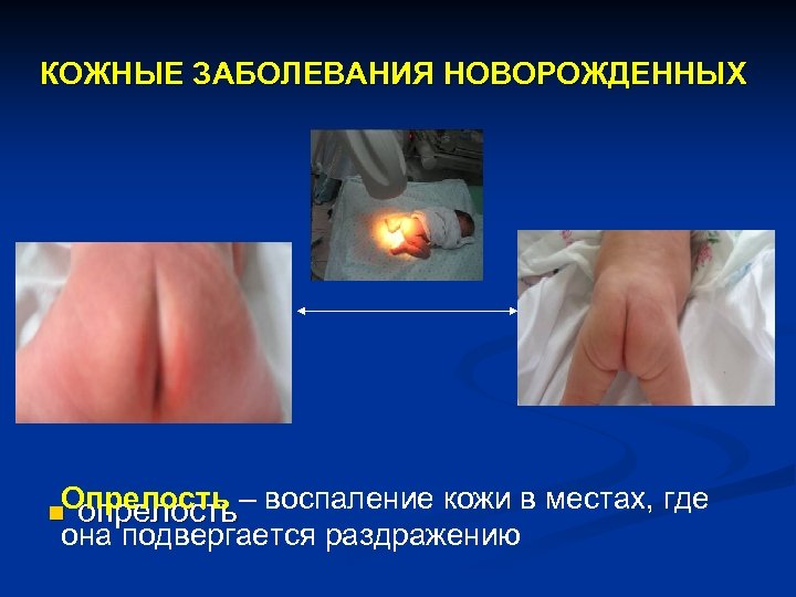 КОЖНЫЕ ЗАБОЛЕВАНИЯ НОВОРОЖДЕННЫХ Опрелость – воспаление кожи в местах, где опрелость она подвергается раздражению