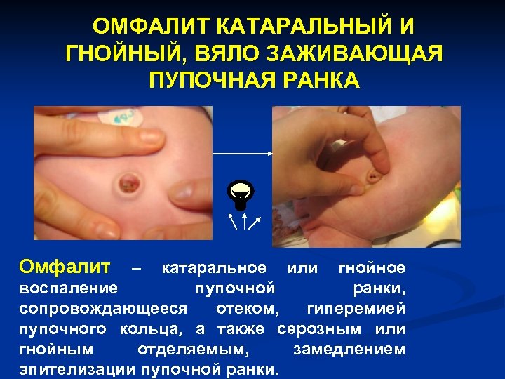ОМФАЛИТ КАТАРАЛЬНЫЙ И ГНОЙНЫЙ, ВЯЛО ЗАЖИВАЮЩАЯ ПУПОЧНАЯ РАНКА Омфалит – катаральное или гнойное воспаление