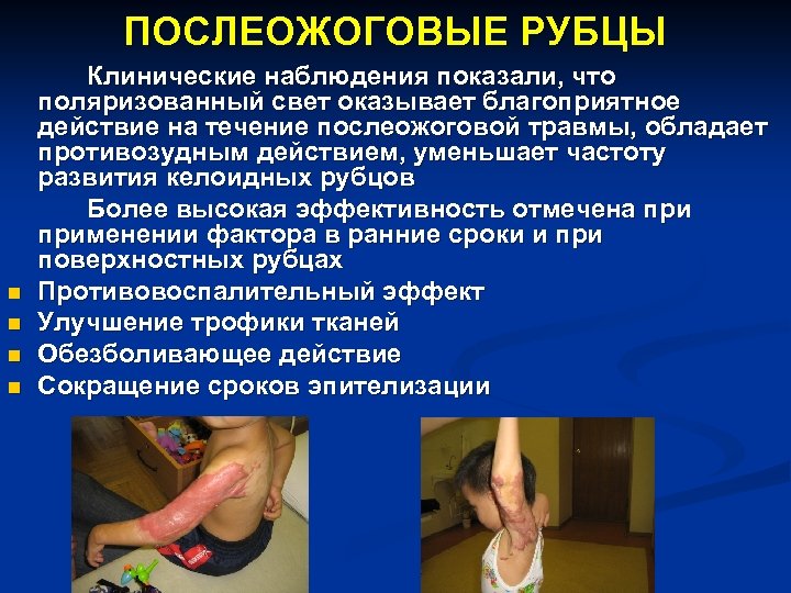 ПОСЛЕОЖОГОВЫЕ РУБЦЫ n n Клинические наблюдения показали, что поляризованный свет оказывает благоприятное действие на