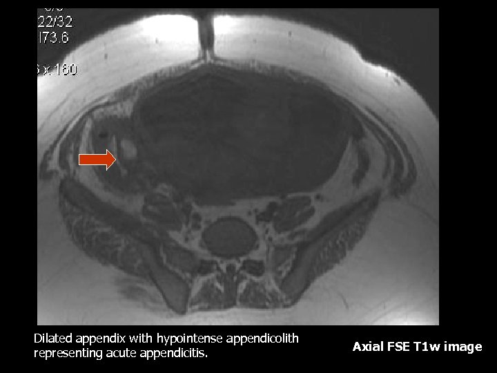 Dilated appendix with hypointense appendicolith representing acute appendicitis. Axial FSE T 1 w image