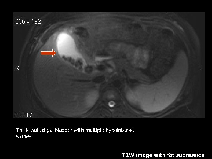 Thick walled gallbladder with multiple hypointense stones T 2 W image with fat supression