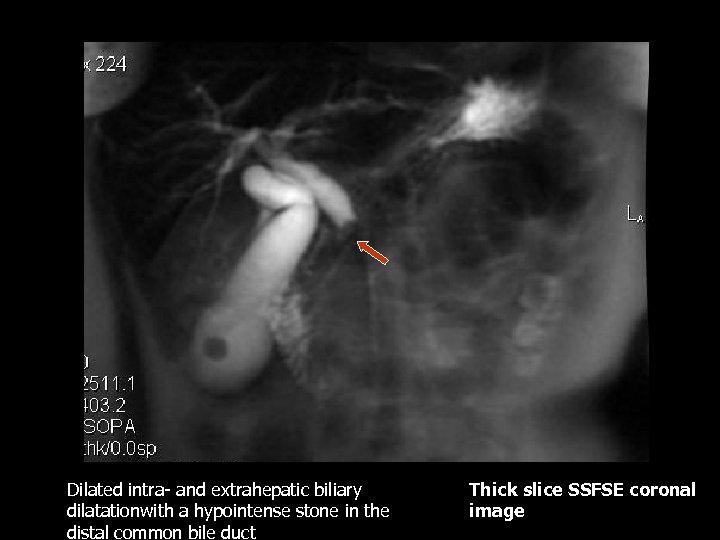 Dilated intra- and extrahepatic biliary dilatationwith a hypointense stone in the distal common bile