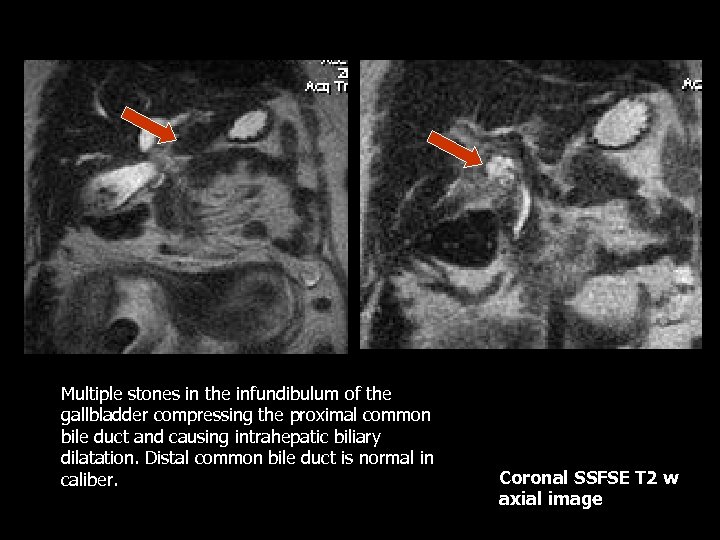Multiple stones in the infundibulum of the gallbladder compressing the proximal common bile duct