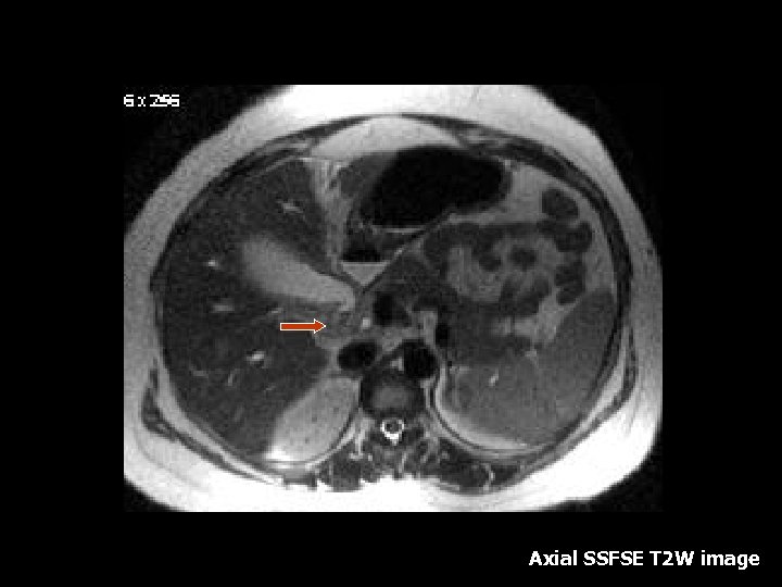 Axial SSFSE T 2 W image 