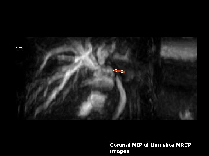 Coronal MIP of thin slice MRCP images 