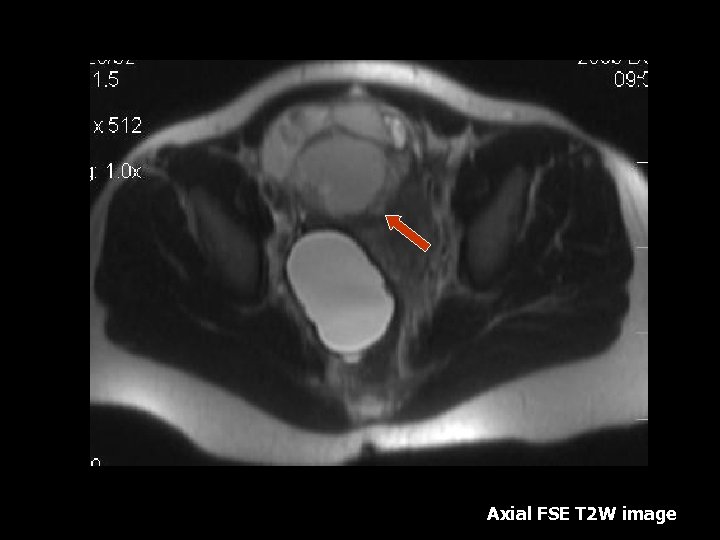 Axial FSE T 2 W image 