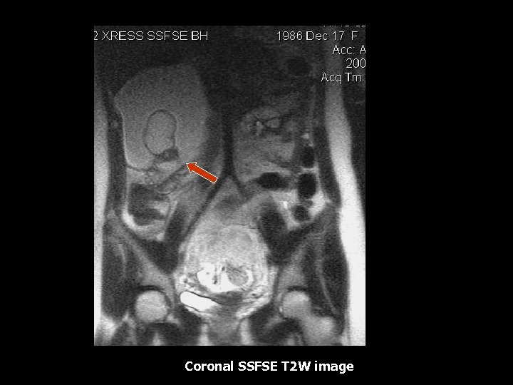 Coronal SSFSE T 2 W image 