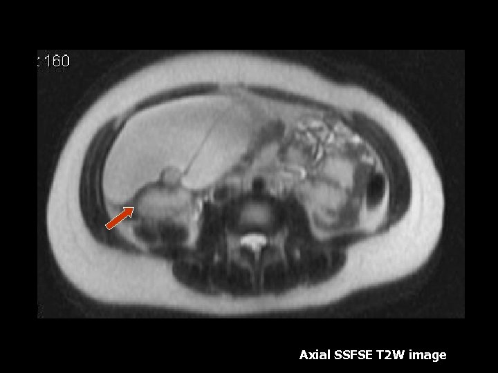 Axial SSFSE T 2 W image 