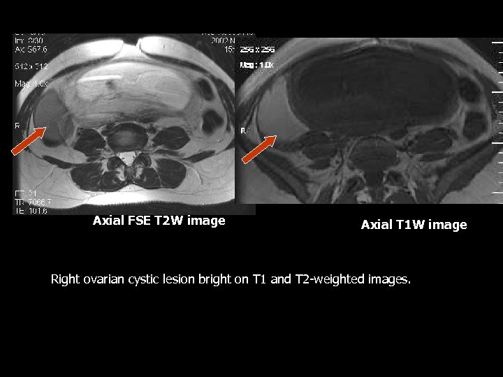 Axial FSE T 2 W image Axial T 1 W image Right ovarian cystic
