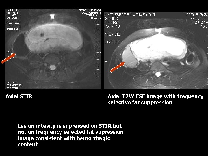 Axial STIR Axial T 2 W FSE image with frequency selective fat suppression Lesion