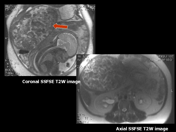 Coronal SSFSE T 2 W image Axial SSFSE T 2 W image 