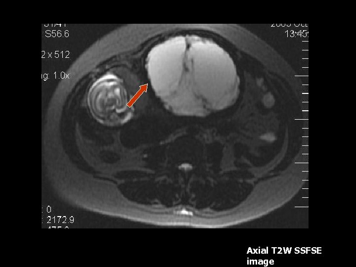 Axial T 2 W SSFSE image 
